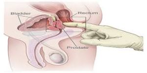 prostate-01-it-is-here