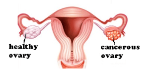 ovarian-cancer-01