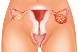 ovarian-cancer-02